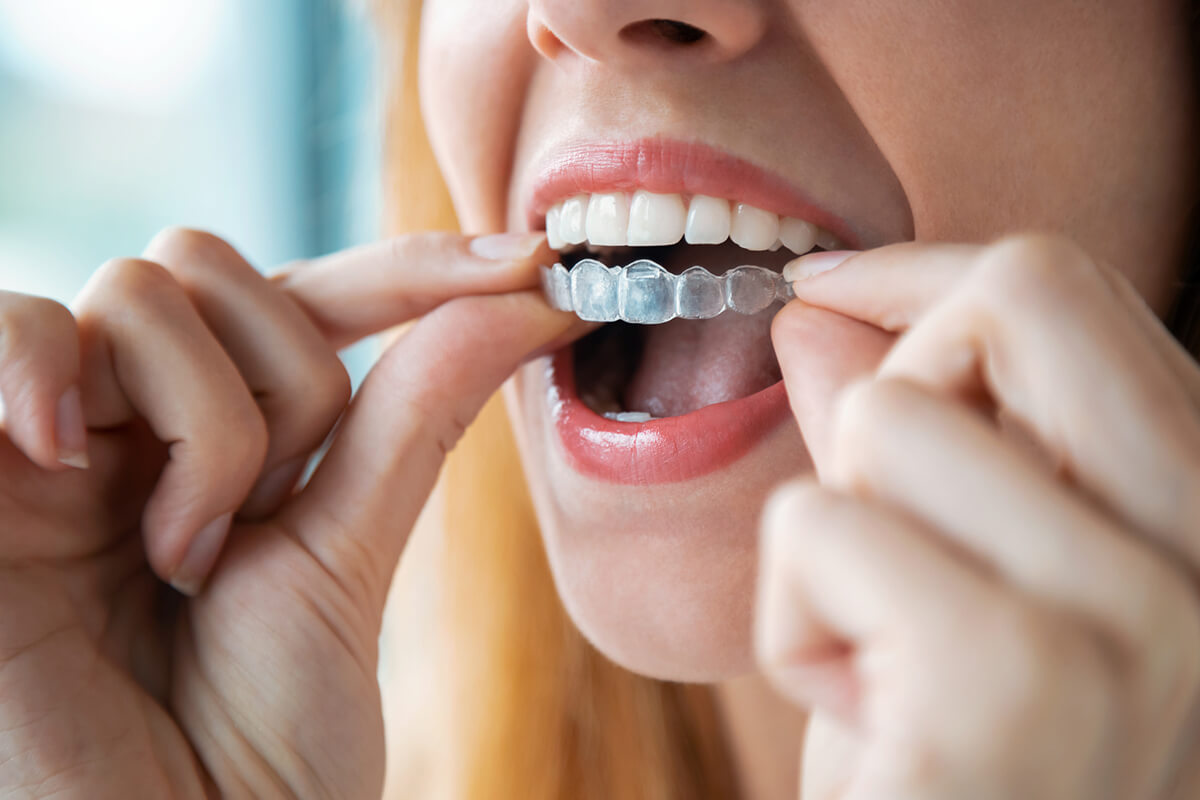 https://www.belladentalnj.com/wp-content/uploads/how-much-is-invisalign-without-insurance-in-monmouth-county-nj-blog.jpg